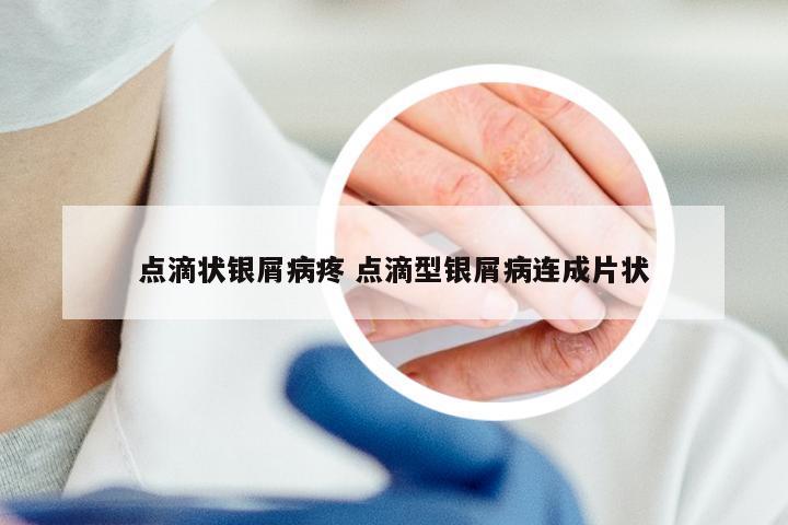 点滴状银屑病疼 点滴型银屑病连成片状