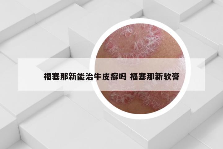 福塞那新能治牛皮癣吗 福塞那新软膏