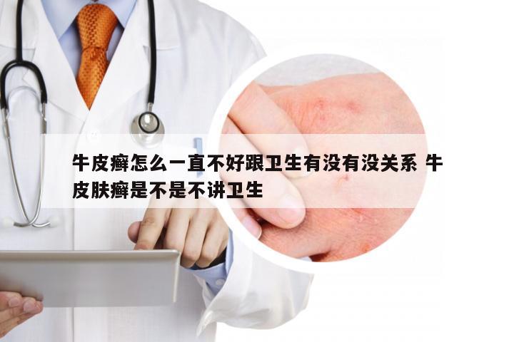 牛皮癣怎么一直不好跟卫生有没有没关系 牛皮肤癣是不是不讲卫生