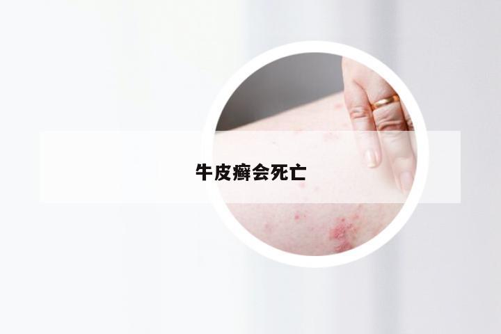 牛皮癣会死亡