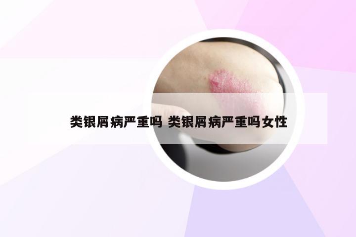 类银屑病严重吗 类银屑病严重吗女性