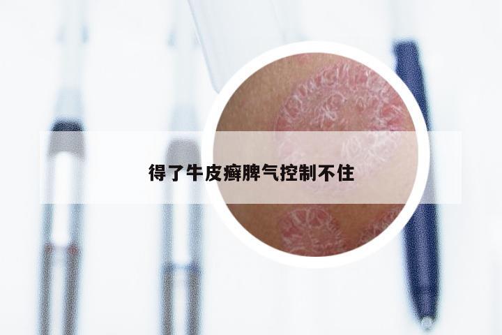 得了牛皮癣脾气控制不住