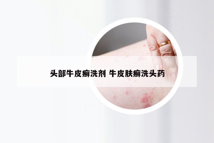 头部牛皮癣洗剂 牛皮肤癣洗头药