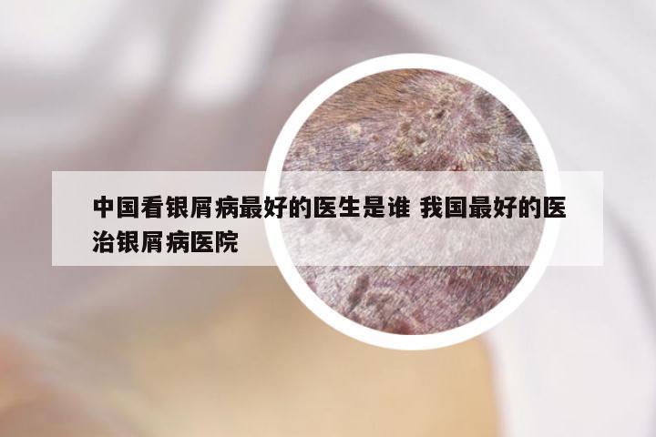 中国看银屑病最好的医生是谁 我国最好的医治银屑病医院