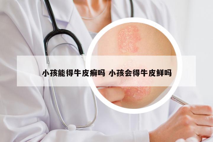 小孩能得牛皮癣吗 小孩会得牛皮鲜吗