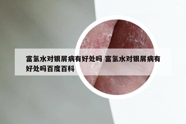 富氢水对银屑病有好处吗 富氢水对银屑病有好处吗百度百科