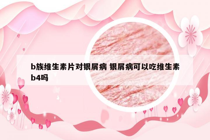 b族维生素片对银屑病 银屑病可以吃维生素b4吗