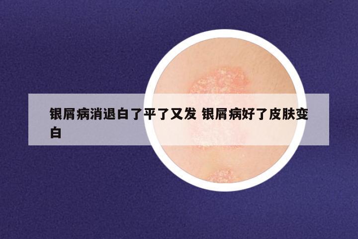 银屑病消退白了平了又发 银屑病好了皮肤变白