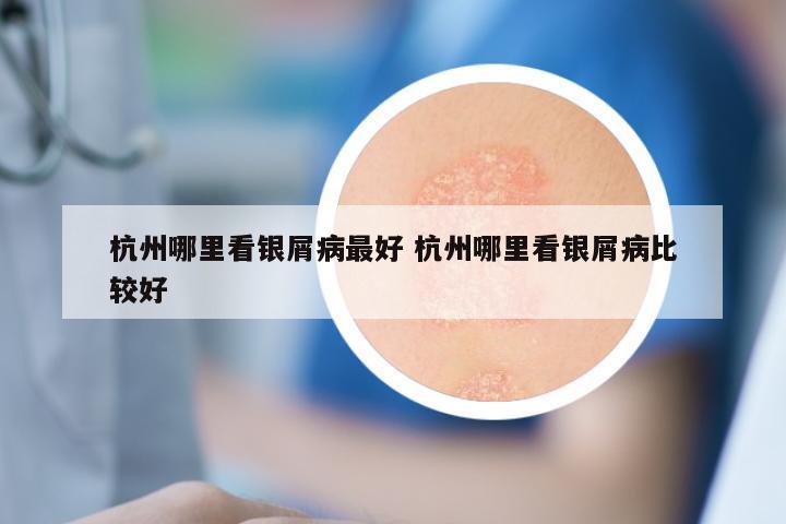杭州哪里看银屑病最好 杭州哪里看银屑病比较好