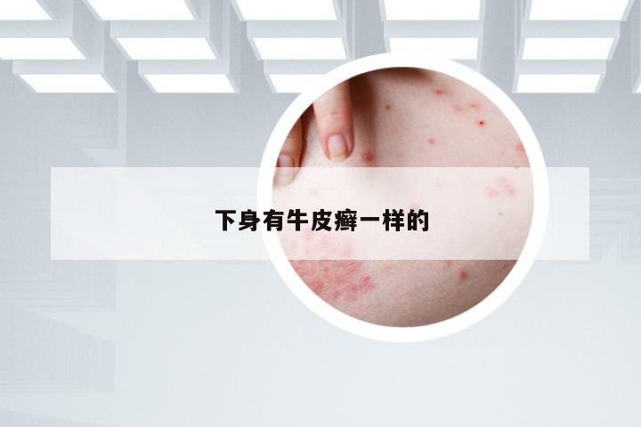 下身有牛皮癣一样的