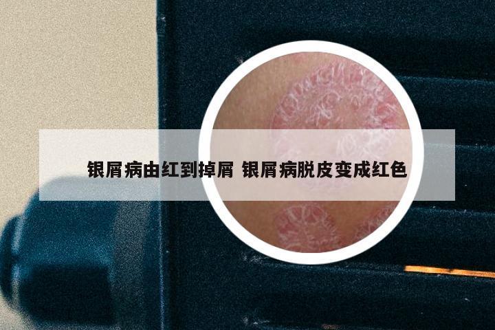 银屑病由红到掉屑 银屑病脱皮变成红色