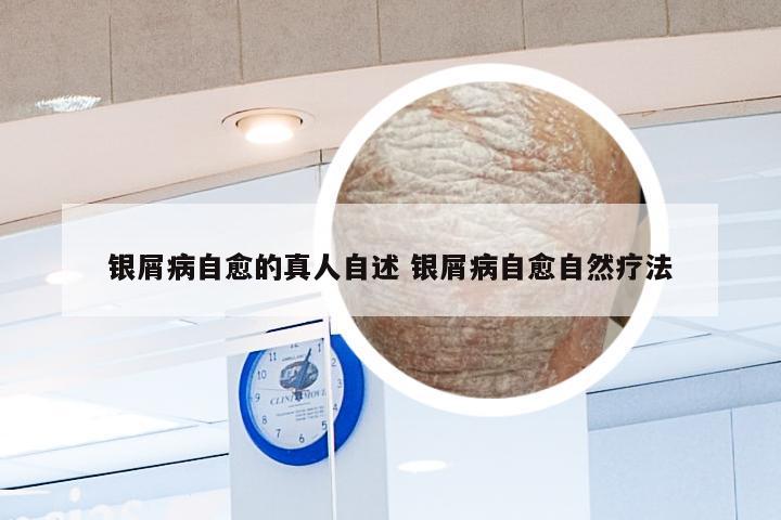 银屑病自愈的真人自述 银屑病自愈自然疗法