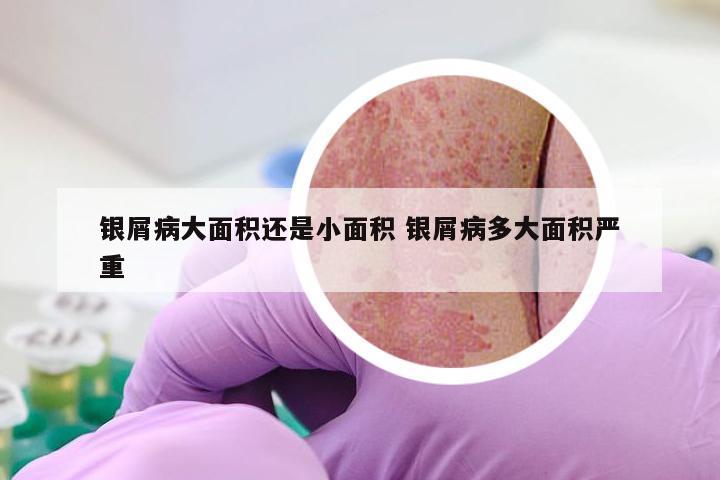 银屑病大面积还是小面积 银屑病多大面积严重