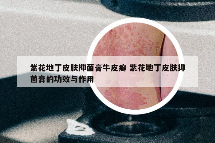 紫花地丁皮肤抑菌膏牛皮癣 紫花地丁皮肤抑菌膏的功效与作用