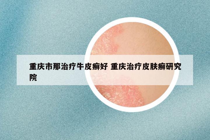 重庆市那治疗牛皮癣好 重庆治疗皮肤癣研究院