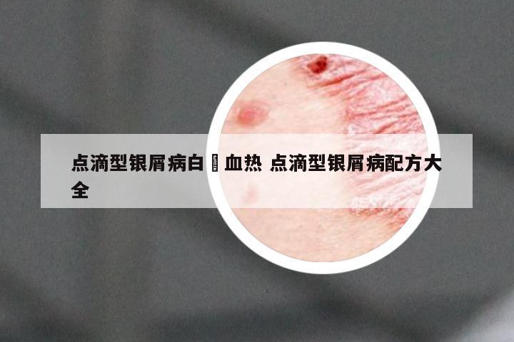 点滴型银屑病白疕血热 点滴型银屑病配方大全