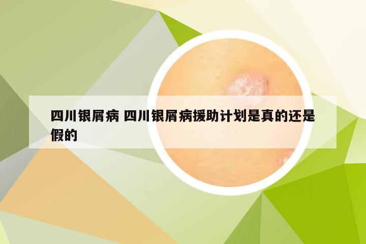 四川银屑病 四川银屑病援助计划是真的还是假的