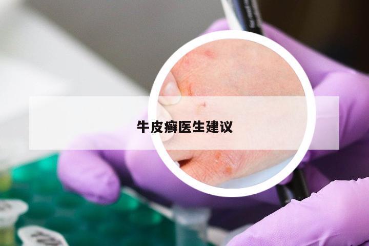 牛皮癣医生建议