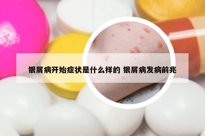银屑病开始症状是什么样的 银屑病发病前兆