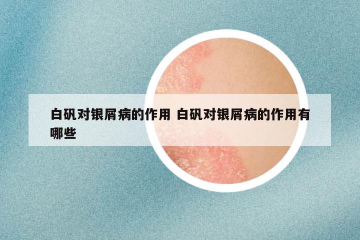 白矾对银屑病的作用 白矾对银屑病的作用有哪些