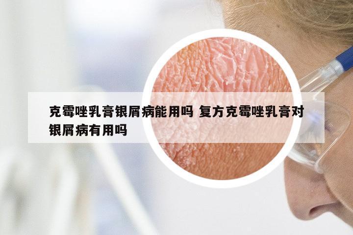 克霉唑乳膏银屑病能用吗 复方克霉唑乳膏对银屑病有用吗