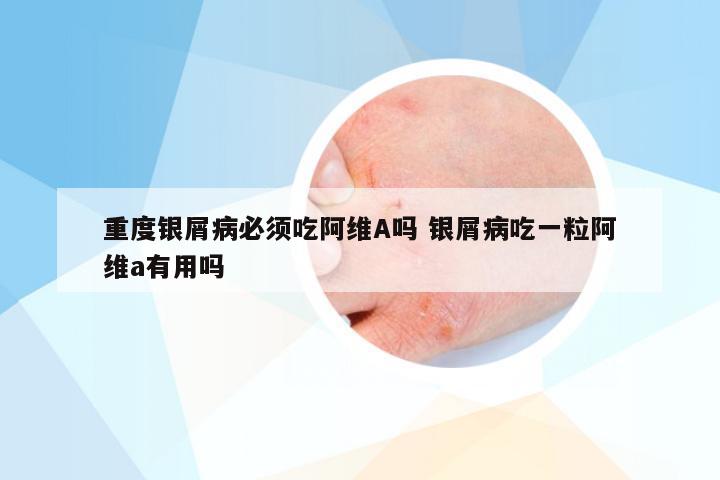 重度银屑病必须吃阿维A吗 银屑病吃一粒阿维a有用吗