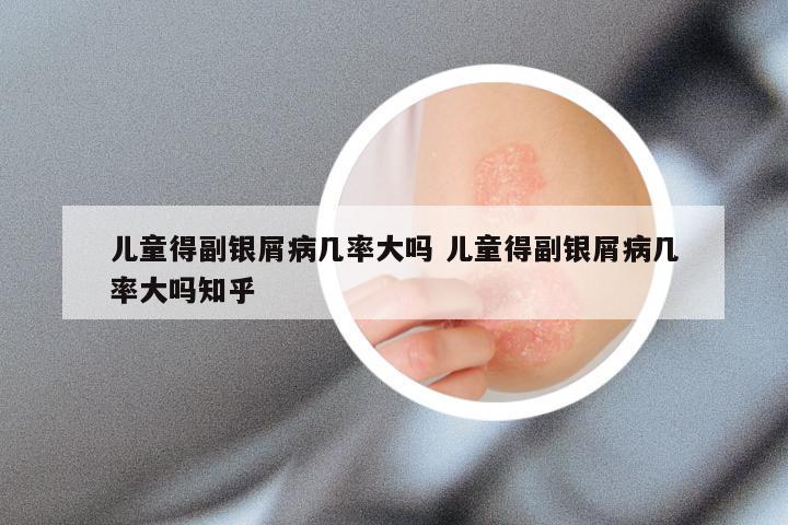 儿童得副银屑病几率大吗 儿童得副银屑病几率大吗知乎