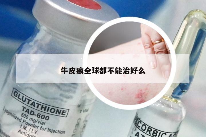 牛皮癣全球都不能治好么