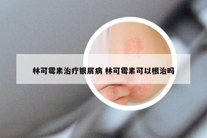 林可霉素治疗银屑病 林可霉素可以根治吗