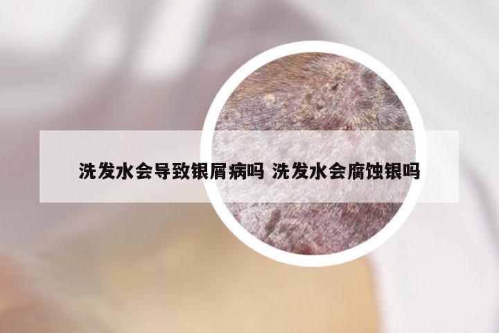 洗发水会导致银屑病吗 洗发水会腐蚀银吗