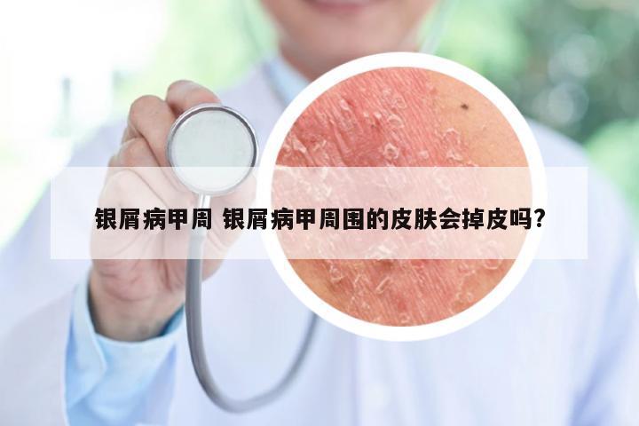 银屑病甲周 银屑病甲周围的皮肤会掉皮吗?
