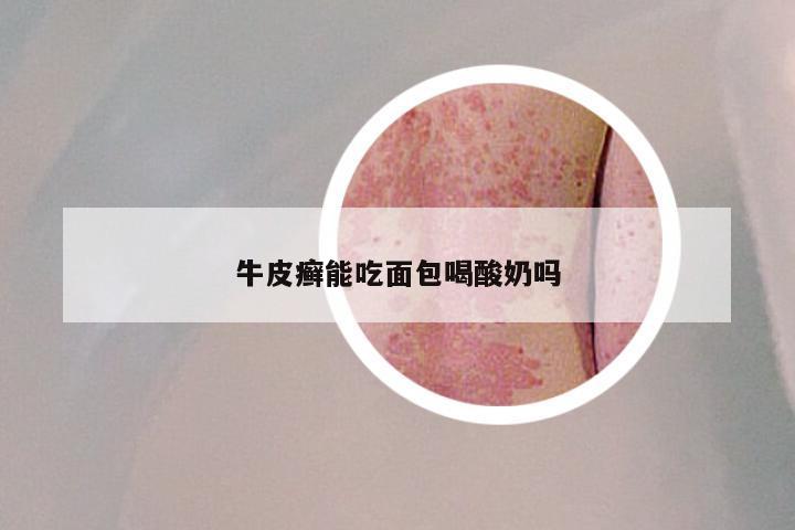 牛皮癣能吃面包喝酸奶吗
