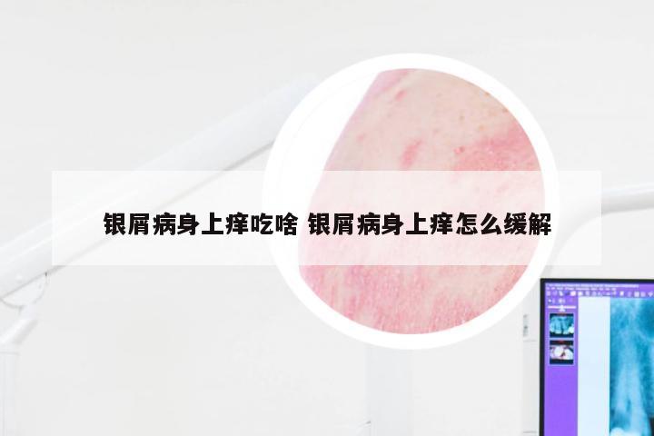 银屑病身上痒吃啥 银屑病身上痒怎么缓解
