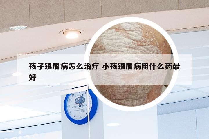 孩子银屑病怎么治疗 小孩银屑病用什么药最好
