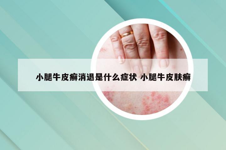 小腿牛皮癣消退是什么症状 小腿牛皮肤癣