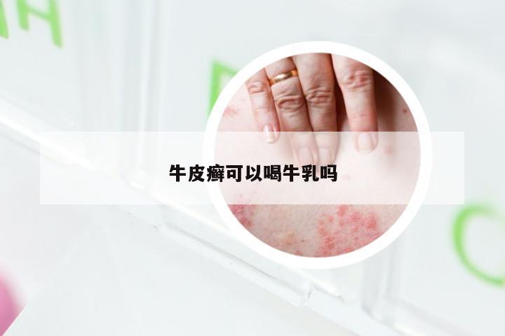 牛皮癣可以喝牛乳吗
