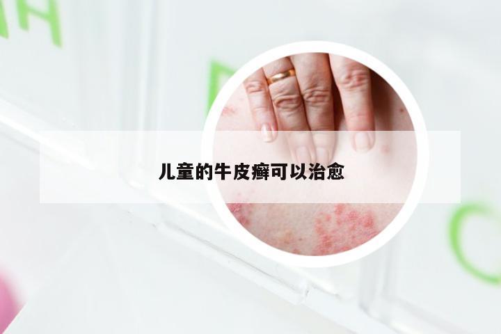 儿童的牛皮癣可以治愈