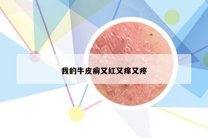 我的牛皮癣又红又痒又疼