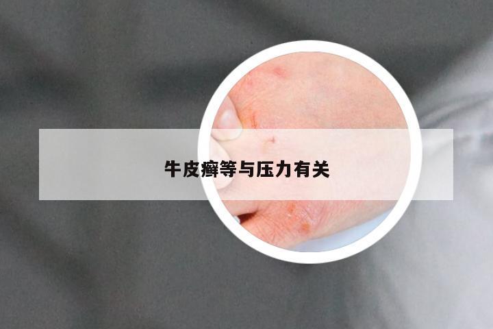 牛皮癣等与压力有关
