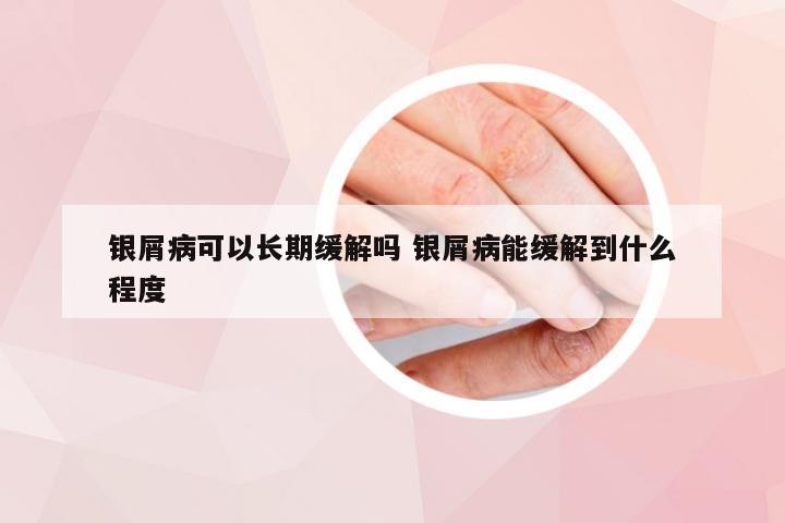 银屑病可以长期缓解吗 银屑病能缓解到什么程度