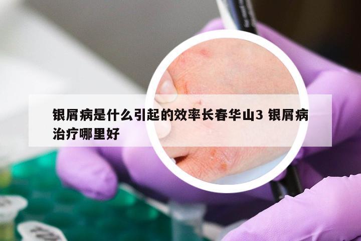 银屑病是什么引起的效率长春华山3 银屑病治疗哪里好