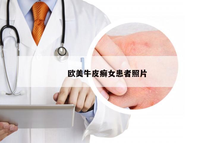 欧美牛皮癣女患者照片