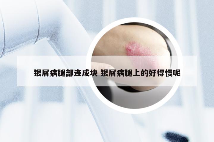 银屑病腿部连成块 银屑病腿上的好得慢呢