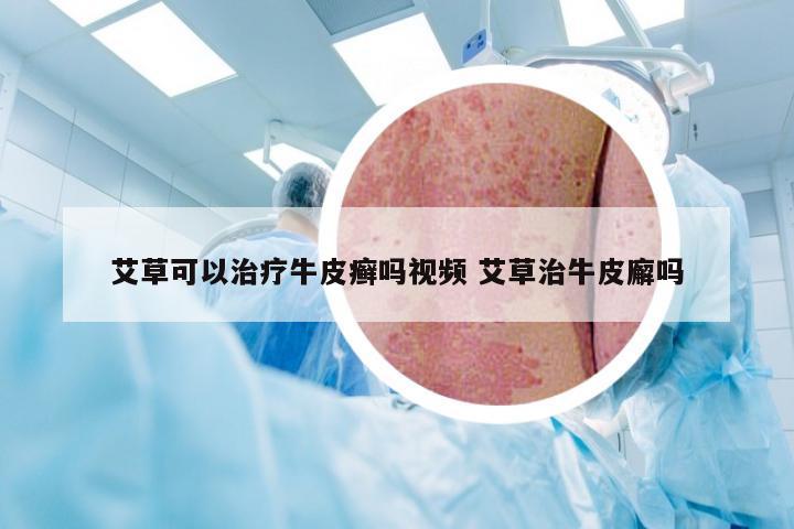 艾草可以治疗牛皮癣吗视频 艾草治牛皮廨吗