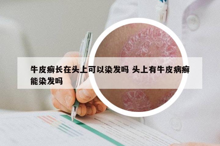 牛皮癣长在头上可以染发吗 头上有牛皮病癣能染发吗