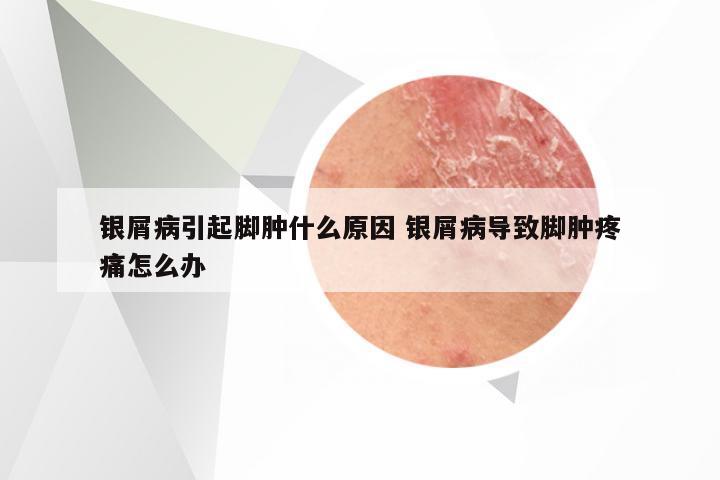 银屑病引起脚肿什么原因 银屑病导致脚肿疼痛怎么办