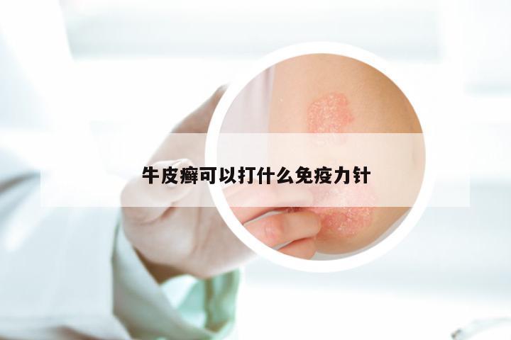 牛皮癣可以打什么免疫力针
