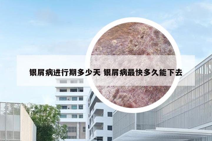 银屑病进行期多少天 银屑病最快多久能下去