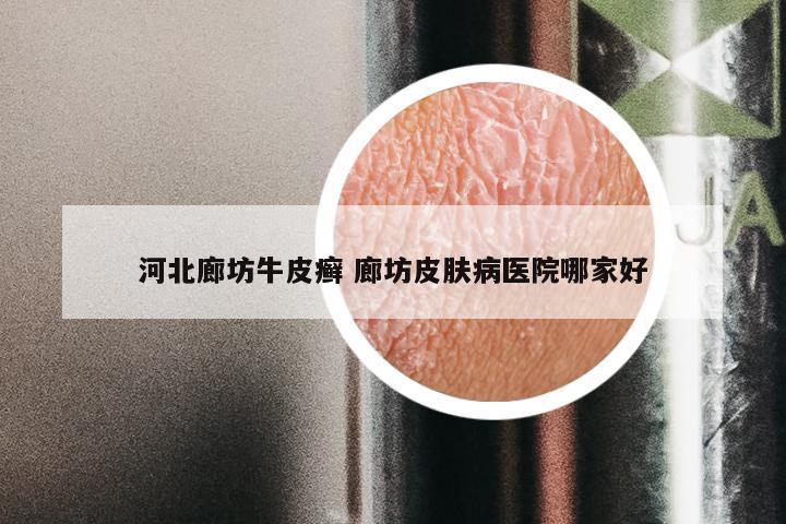 河北廊坊牛皮癣 廊坊皮肤病医院哪家好