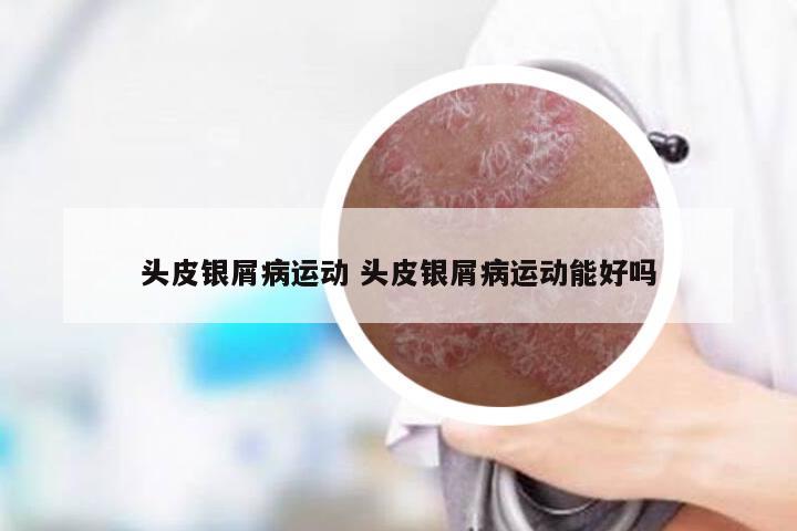 头皮银屑病运动 头皮银屑病运动能好吗